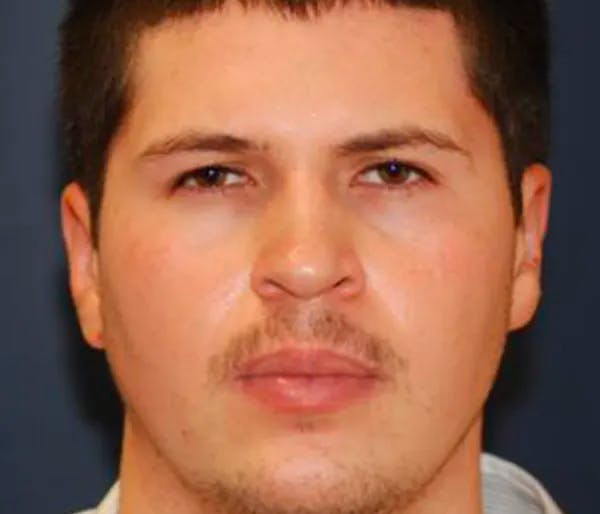 Before and After Otoplasty in Houston