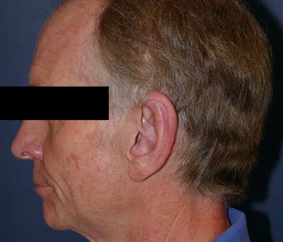 Ear Pinning (Otoplasty) Gallery - Patient 43670706 - Image 6