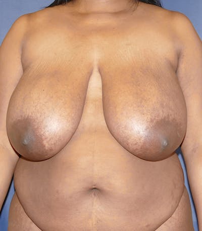 Breast Reduction Gallery - Patient 57939162 - Image 1