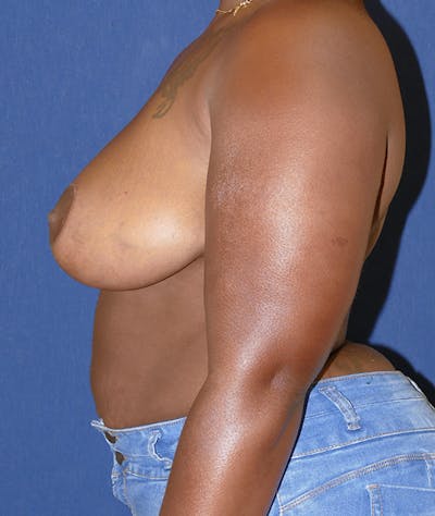 Breast Reduction Gallery - Patient 43640034 - Image 4