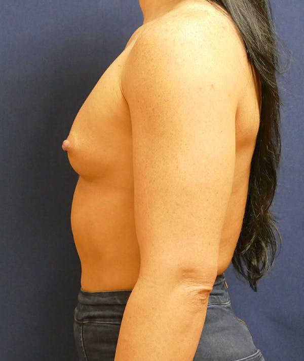 Breast Augmentation Gallery - Patient 57939209 - Image 9
