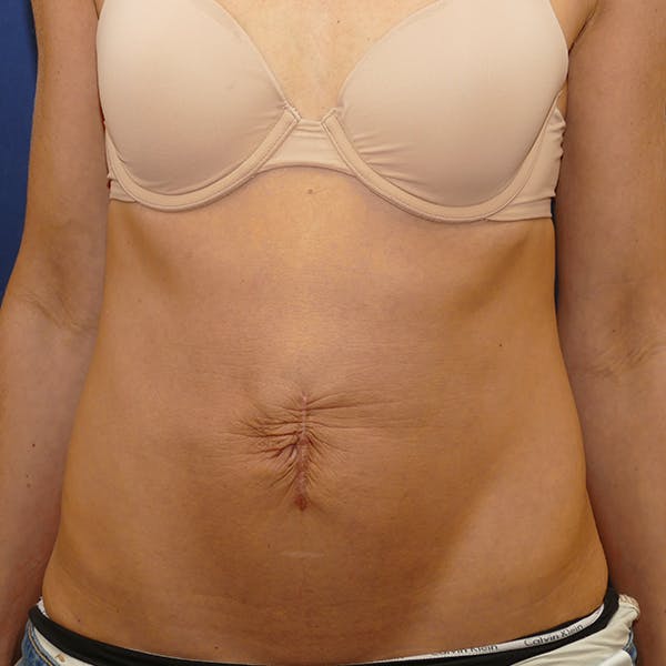 Tummy Tuck (Abdominoplasty) Gallery - Patient 57939254 - Image 1