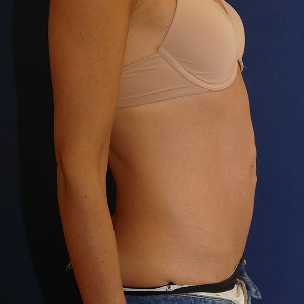 Tummy Tuck (Abdominoplasty) Gallery - Patient 57939254 - Image 3