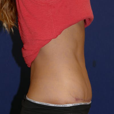 Tummy Tuck (Abdominoplasty) Gallery - Patient 57939254 - Image 4