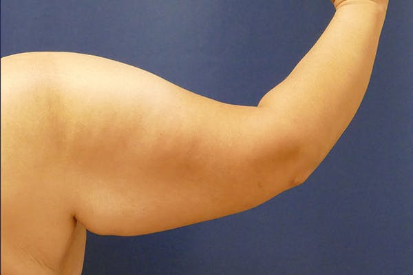 Arm Lift (Brachioplasty) Gallery - Patient 57939261 - Image 3