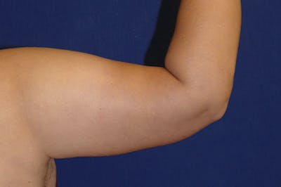 Arm Lift (Brachioplasty) Gallery - Patient 57939261 - Image 4