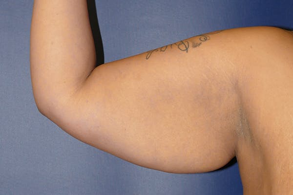 Arm Lift (Brachioplasty) Gallery - Patient 71702815 - Image 5