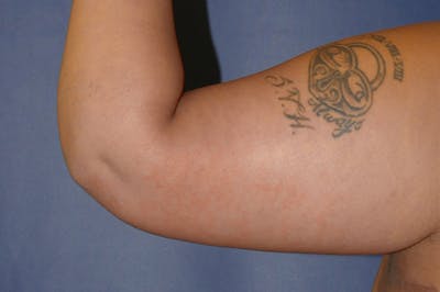 Arm Lift (Brachioplasty) Gallery - Patient 71702815 - Image 8