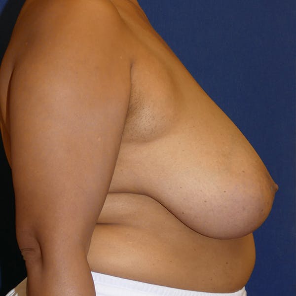 Breast Reduction Gallery - Patient 71702839 - Image 3