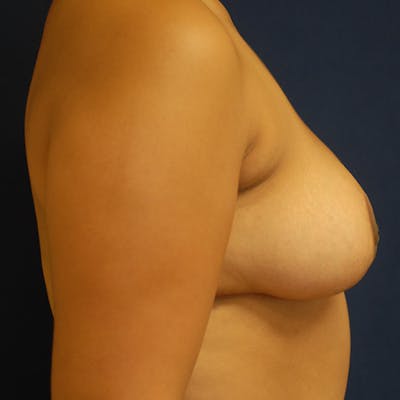 Breast Reduction Gallery - Patient 71702851 - Image 8