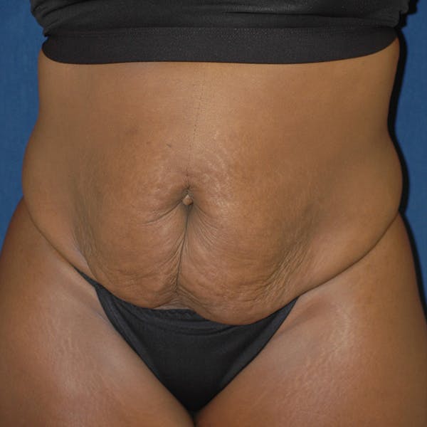 Tummy Tuck (Abdominoplasty) Gallery - Patient 71702874 - Image 1