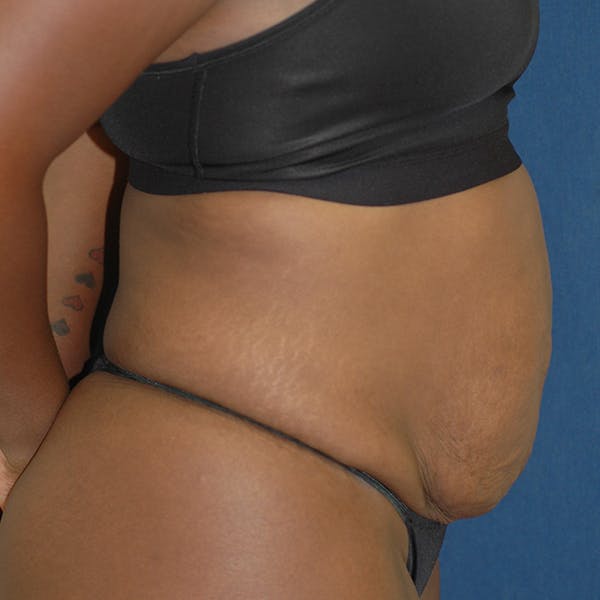 Tummy Tuck (Abdominoplasty) Gallery - Patient 71702874 - Image 7