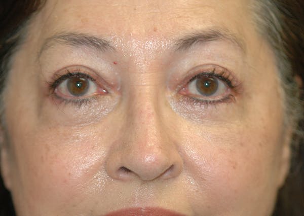 Eyelid Lift (Blepharoplasty) Gallery - Patient 71702939 - Image 2