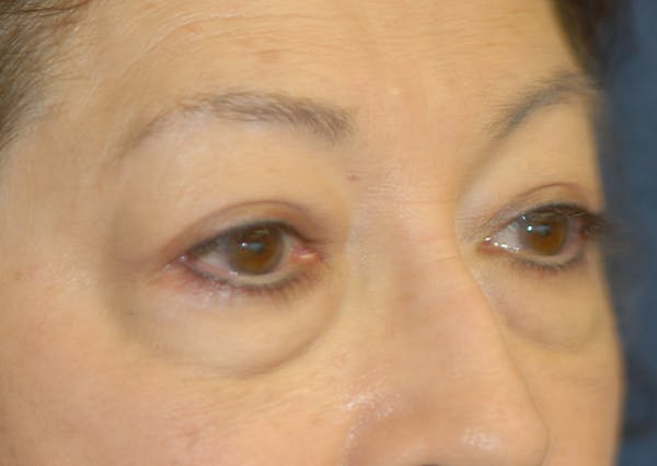 Eyelid Lift (Blepharoplasty) Gallery - Patient 71702939 - Image 7