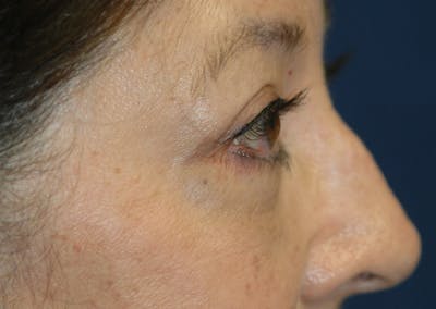 Eyelid Lift (Blepharoplasty) Gallery - Patient 71702939 - Image 10