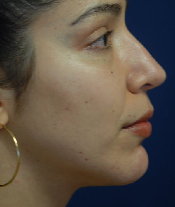 Chin Augmentation Gallery - Patient 85204094 - Image 2
