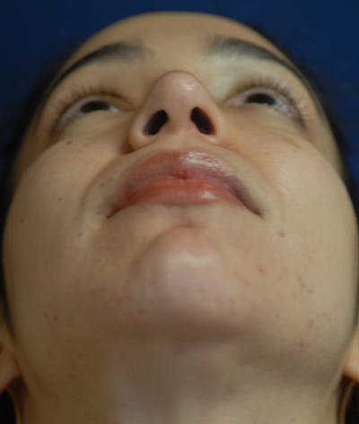 Chin Augmentation Gallery - Patient 85204094 - Image 14