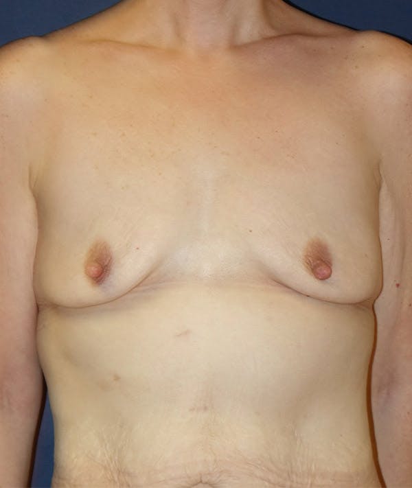 Breast Augmentation Gallery - Patient 85204111 - Image 1