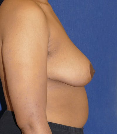 Breast Reduction Gallery - Patient 85204134 - Image 10