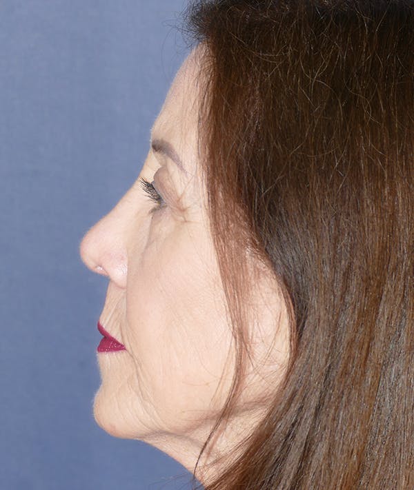 Rhinoplasty Gallery - Patient 85204074 - Image 2