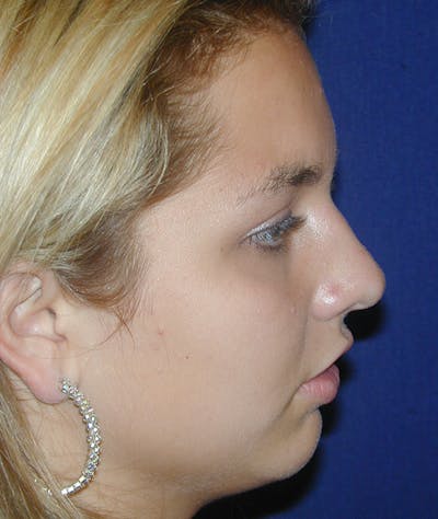 Rhinoplasty Gallery - Patient 110638228 - Image 1