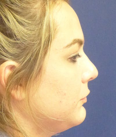 Rhinoplasty Gallery - Patient 110638228 - Image 2