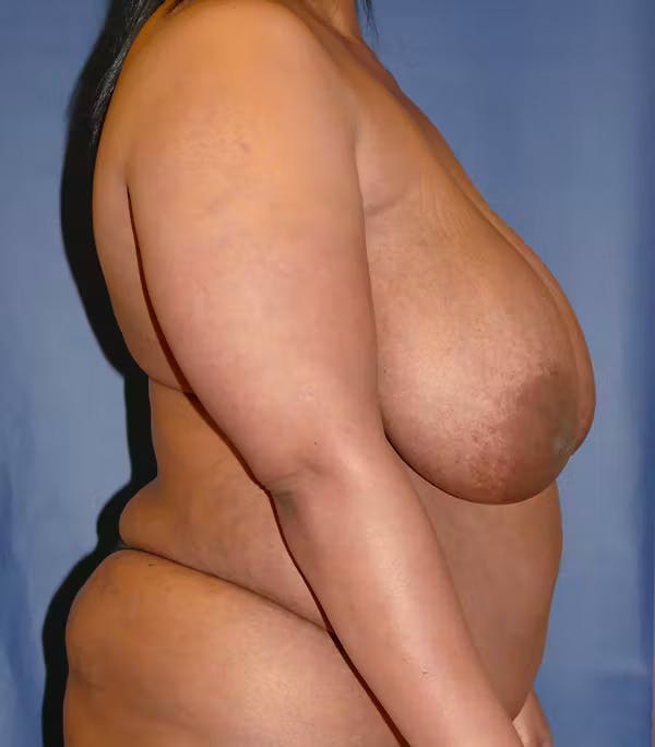 Breast Reduction Gallery - Patient 57939162 - Image 5