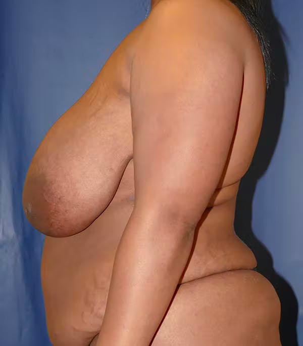 Breast Reduction Gallery - Patient 57939162 - Image 9