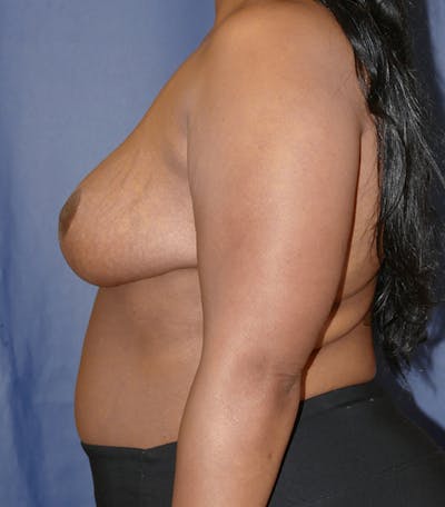 Breast Reduction Gallery - Patient 57939162 - Image 10
