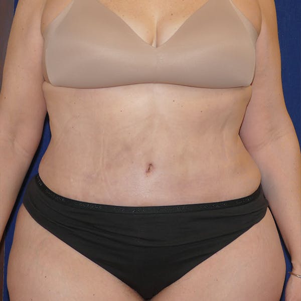 Tummy Tuck (Abdominoplasty) Gallery - Patient 110638746 - Image 2