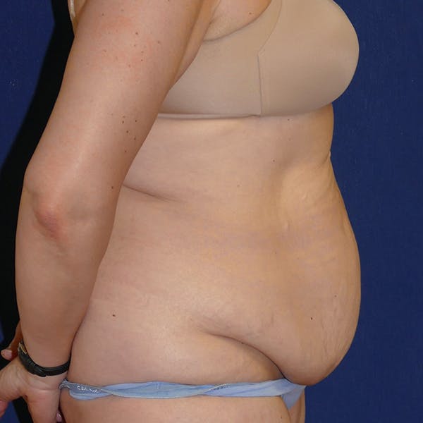 Tummy Tuck (Abdominoplasty) Gallery - Patient 110638746 - Image 3