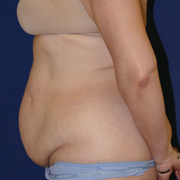 Tummy Tuck (Abdominoplasty) Gallery - Patient 110638746 - Image 7