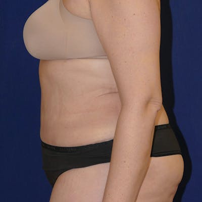 Tummy Tuck (Abdominoplasty) Gallery - Patient 110638746 - Image 8