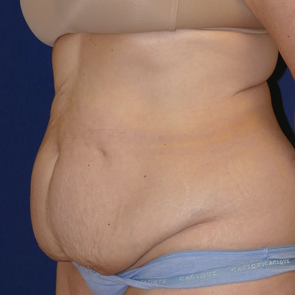 Tummy Tuck (Abdominoplasty) Gallery - Patient 110638746 - Image 9