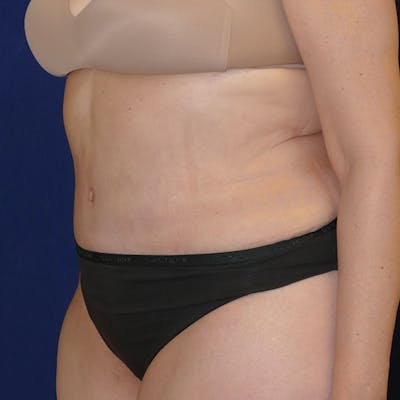 Tummy Tuck (Abdominoplasty) Gallery - Patient 110638746 - Image 10