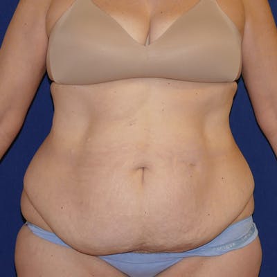 Liposuction Gallery - Patient 110638983 - Image 1