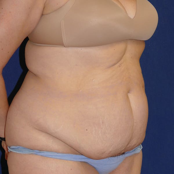 Liposuction Gallery - Patient 110638983 - Image 5