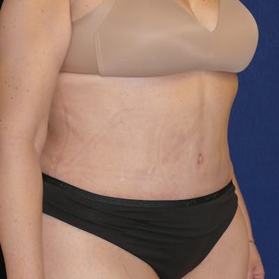 Liposuction Gallery - Patient 110638983 - Image 6
