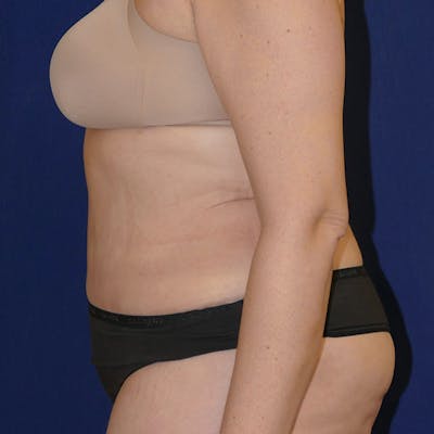 Liposuction Gallery - Patient 110638983 - Image 8