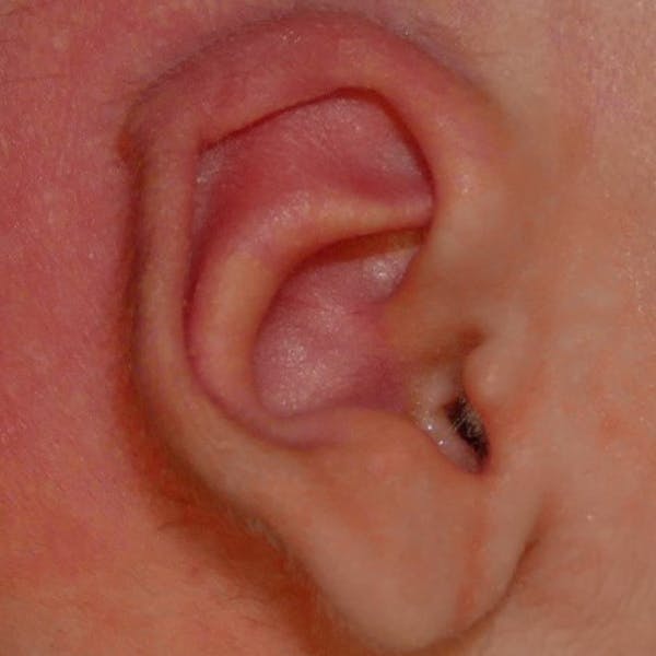 Pediatric Ear Molding Gallery - Patient 110639045 - Image 2