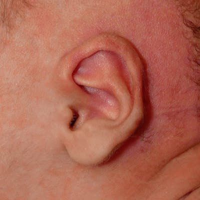 Pediatric Ear Molding Gallery - Patient 110639045 - Image 4