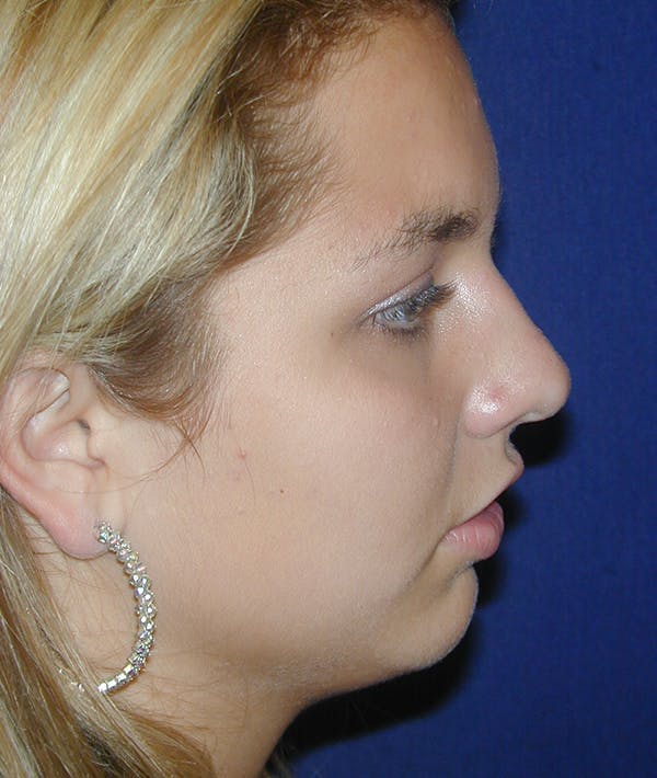 Chin Augmentation Gallery - Patient 110639082 - Image 1
