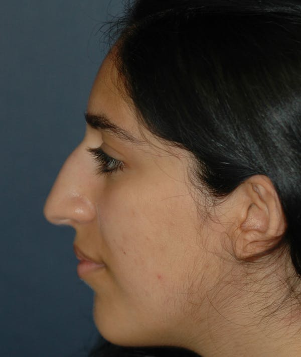 Rhinoplasty Gallery - Patient 118001326 - Image 7