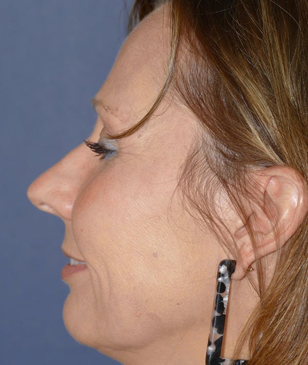 Rhinoplasty Gallery - Patient 118001452 - Image 3