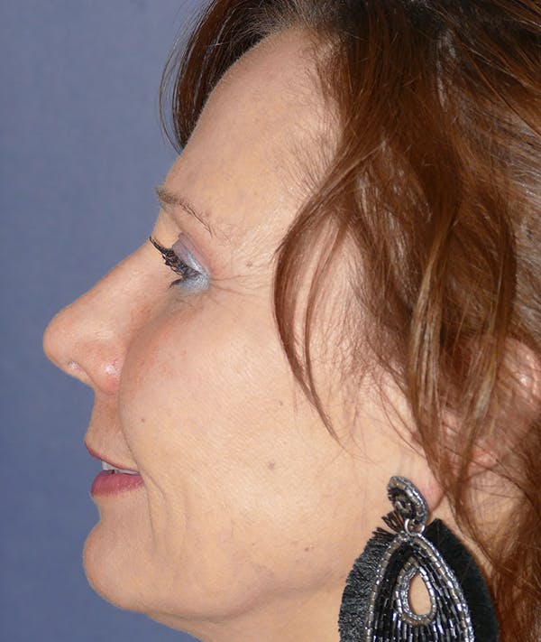 Rhinoplasty Gallery - Patient 118001452 - Image 4