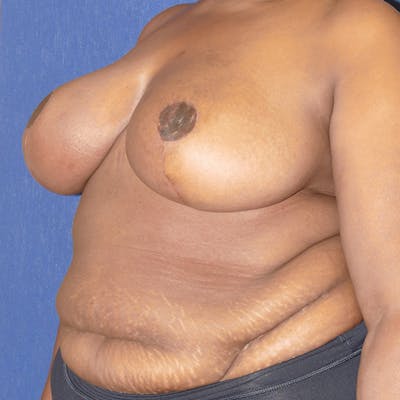 Breast Reduction Gallery - Patient 118001580 - Image 8
