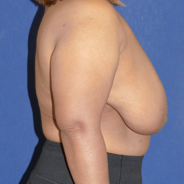 Breast Reduction Gallery - Patient 118001912 - Image 5