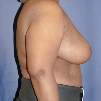 Breast Reduction Gallery - Patient 118001912 - Image 6