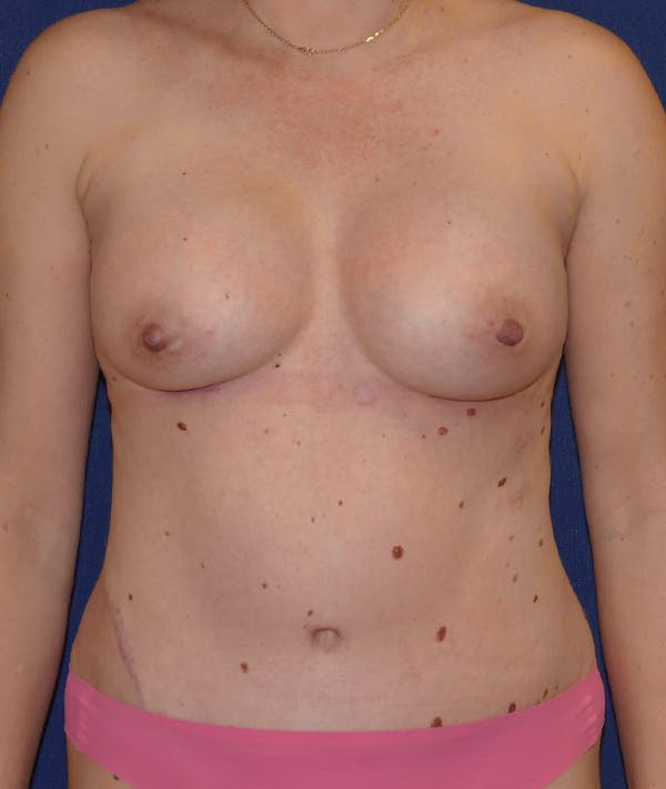 Breast Augmentation Gallery - Patient 118002373 - Image 2
