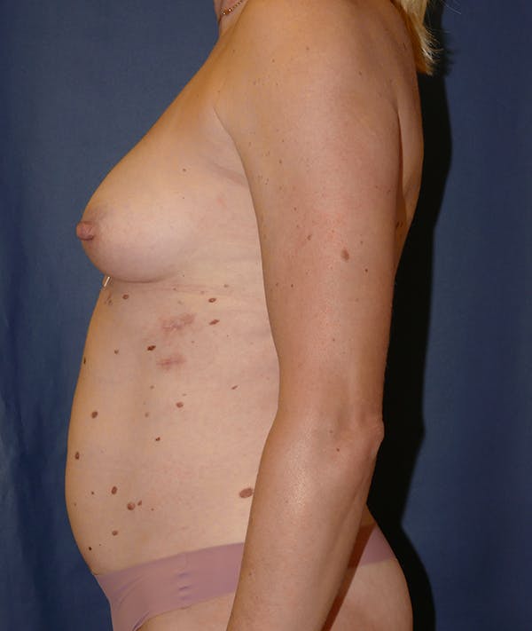 Breast Augmentation Gallery - Patient 118002373 - Image 3
